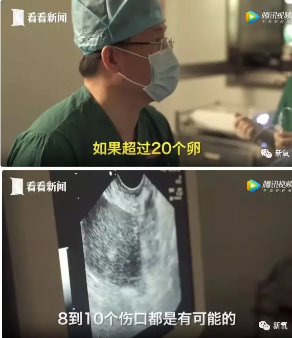 那些为了钱卖自己卵子的女生后来都怎样了？