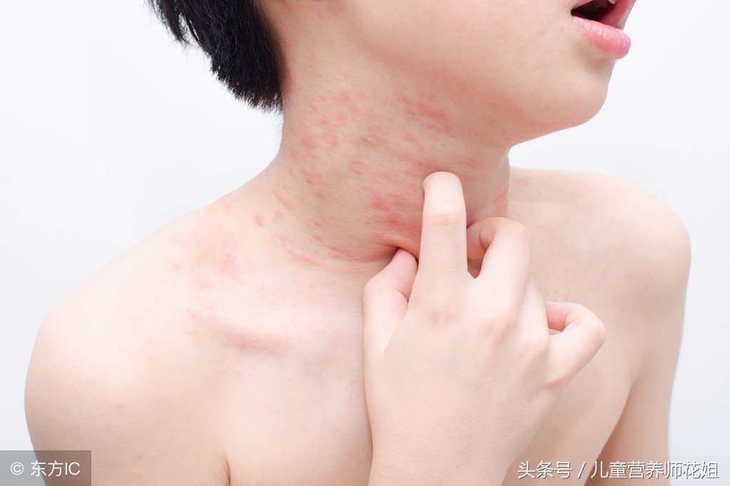 荨麻疹成因和根治方法,麻疹和荨麻疹有什么区别能治好吗