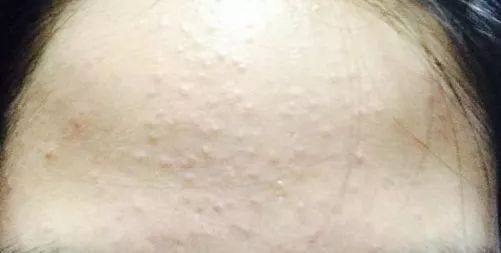 脸上长闭口怎么办教你正确祛闭口,脸上反复长闭口的原因和解决方法