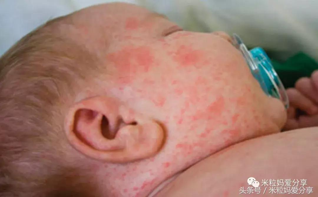宝宝起疹的最佳治疗方法,孩子发烧后出疹怎么护理