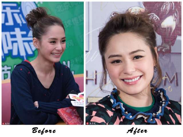 阿娇整牙,阿娇整牙前后对比