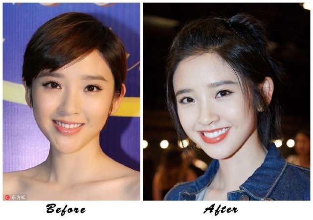 阿娇整牙,阿娇整牙前后对比