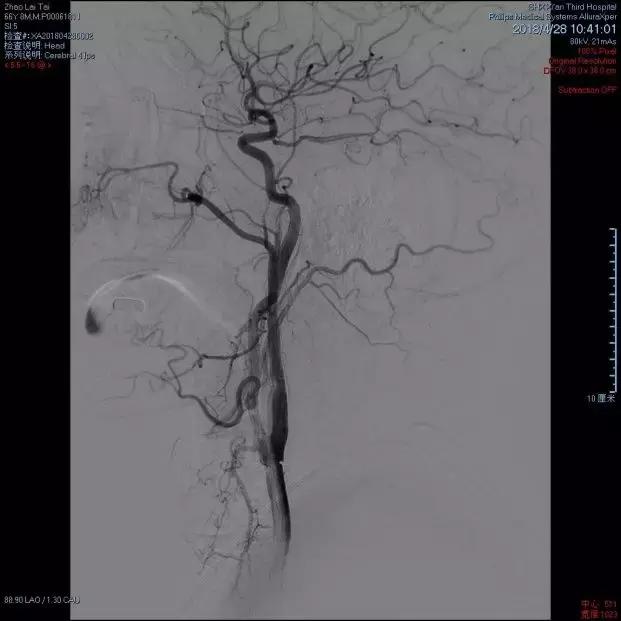 西安市第三人民医院血管外科,治疗颈动脉斑块西安哪家医院好