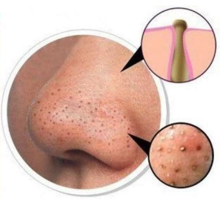 去黑头草莓鼻最有效的方法,怎么去黑头不会变草莓鼻