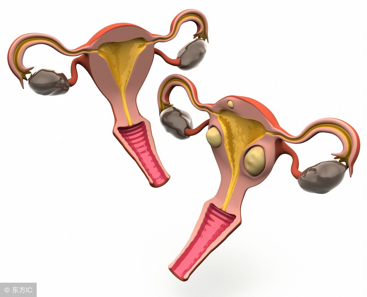 宫颈肥大的病因与病理改变