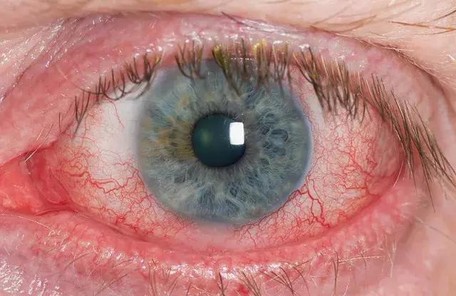 深海鱼油干眼症,干眼症需要补充鱼油吗