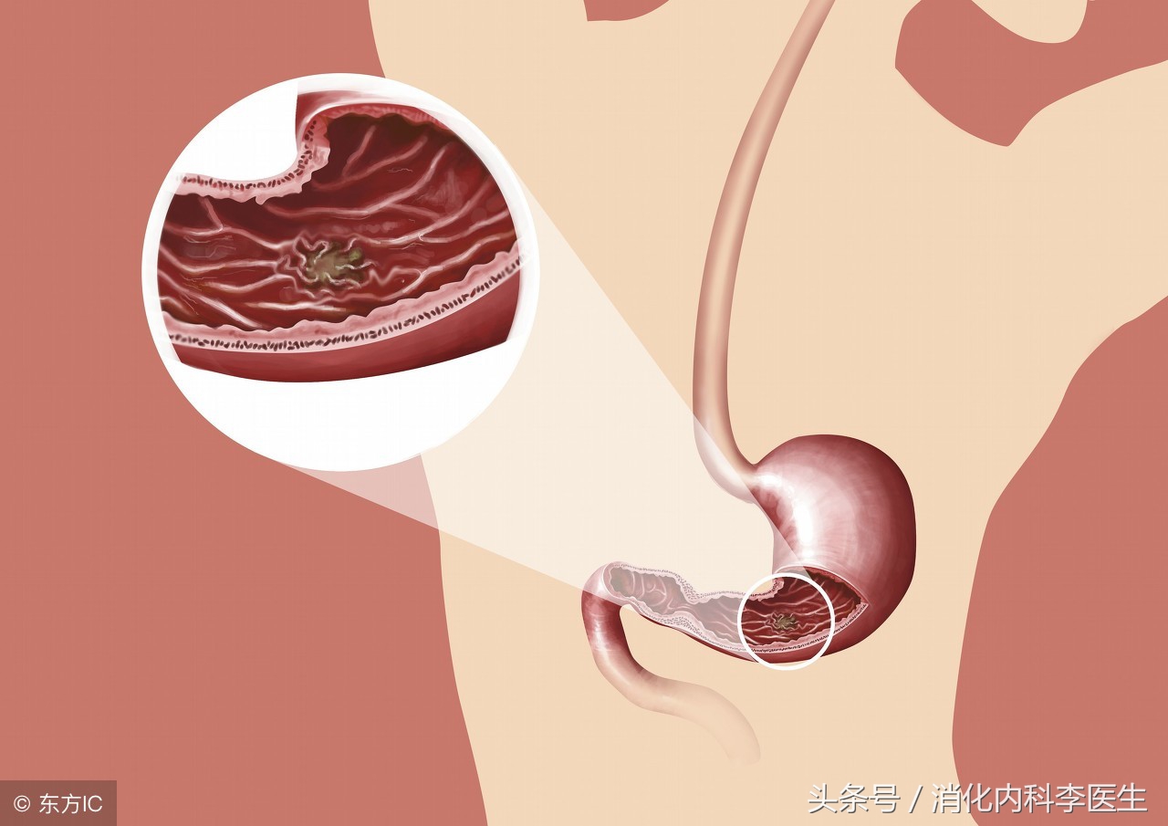 胃病专家讲胃溃疡,中医李大夫治疗胃溃疡