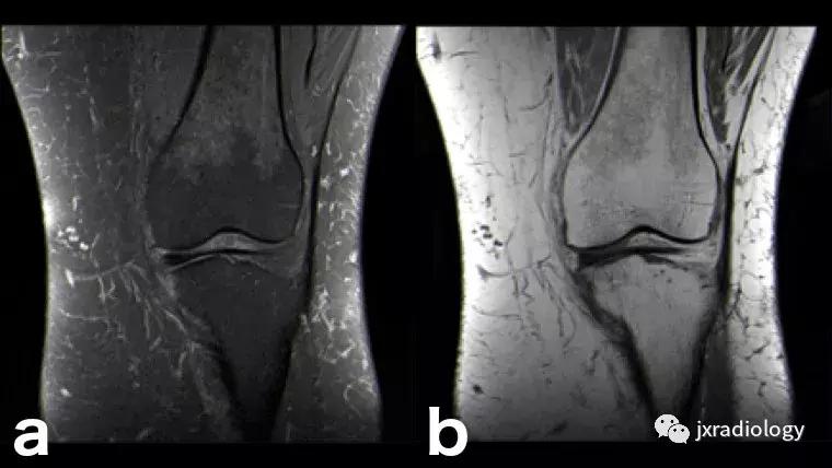 膝关节骨髓水肿疼痛特点,膝关节骨髓水肿的临床表现