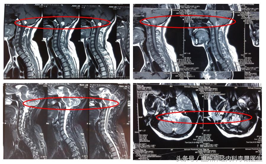 简述脑出血的内科治疗,脑出血中医解析