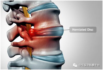 腰背部疼痛什么原因引起的,腰上背部疼痛是什么原因