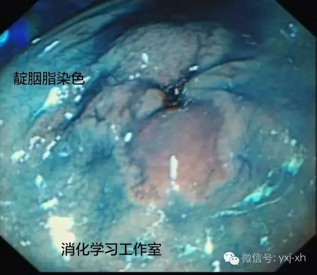 肠上皮化生会引发什么病,胃部肠上皮化生一定会癌变吗