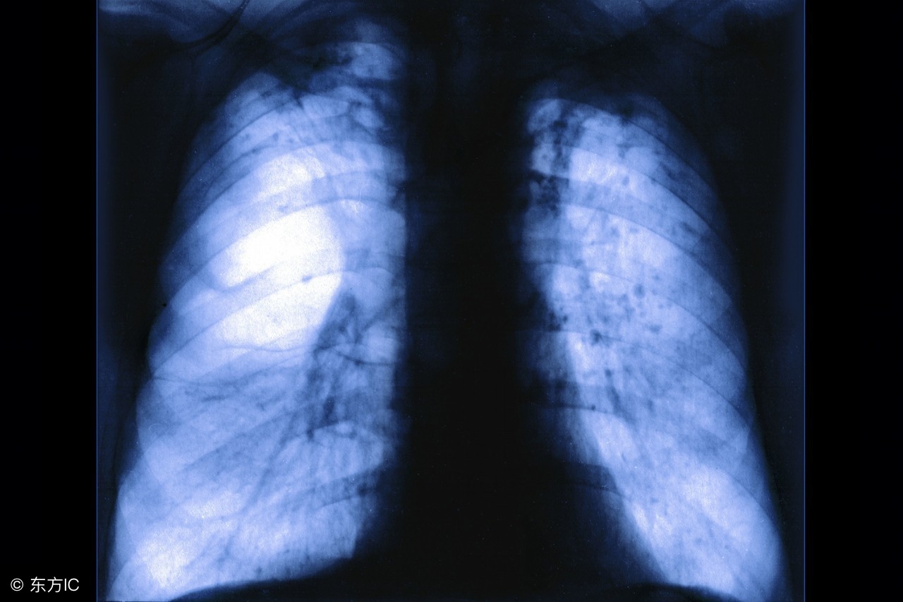 肺气肿吃什么食物可以调理,肺气肿该吃哪些食物比较好