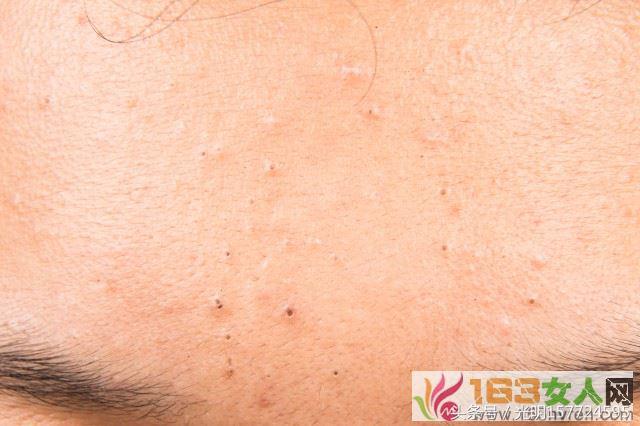 额头长痘的原因和解决方法,额头脸上长痘的原因和解决方法