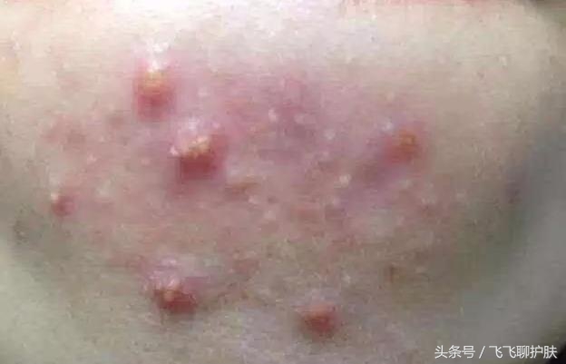 各种痘痘的类型及治疗方法,四种常见的痘痘类型应该如何区分