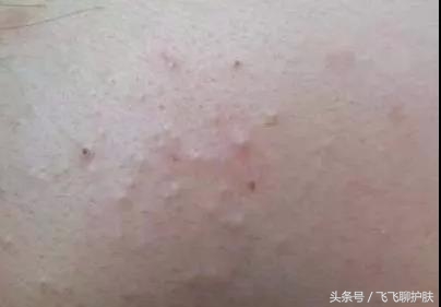 大概只有自己最清楚为什么长痘,各种痘痘类型都是如何产生的