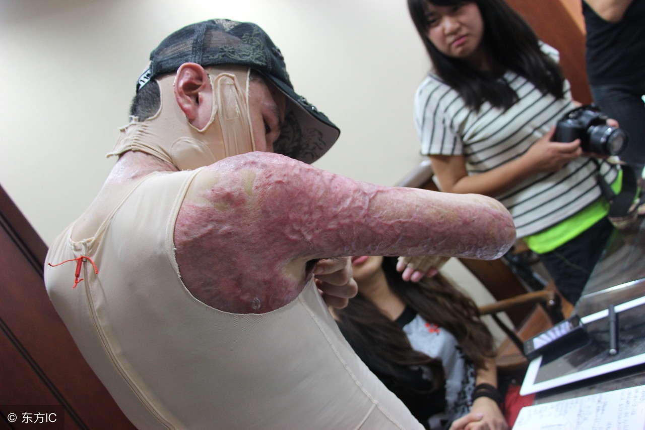 大面积烧伤救命床,烧伤怎么救命最好