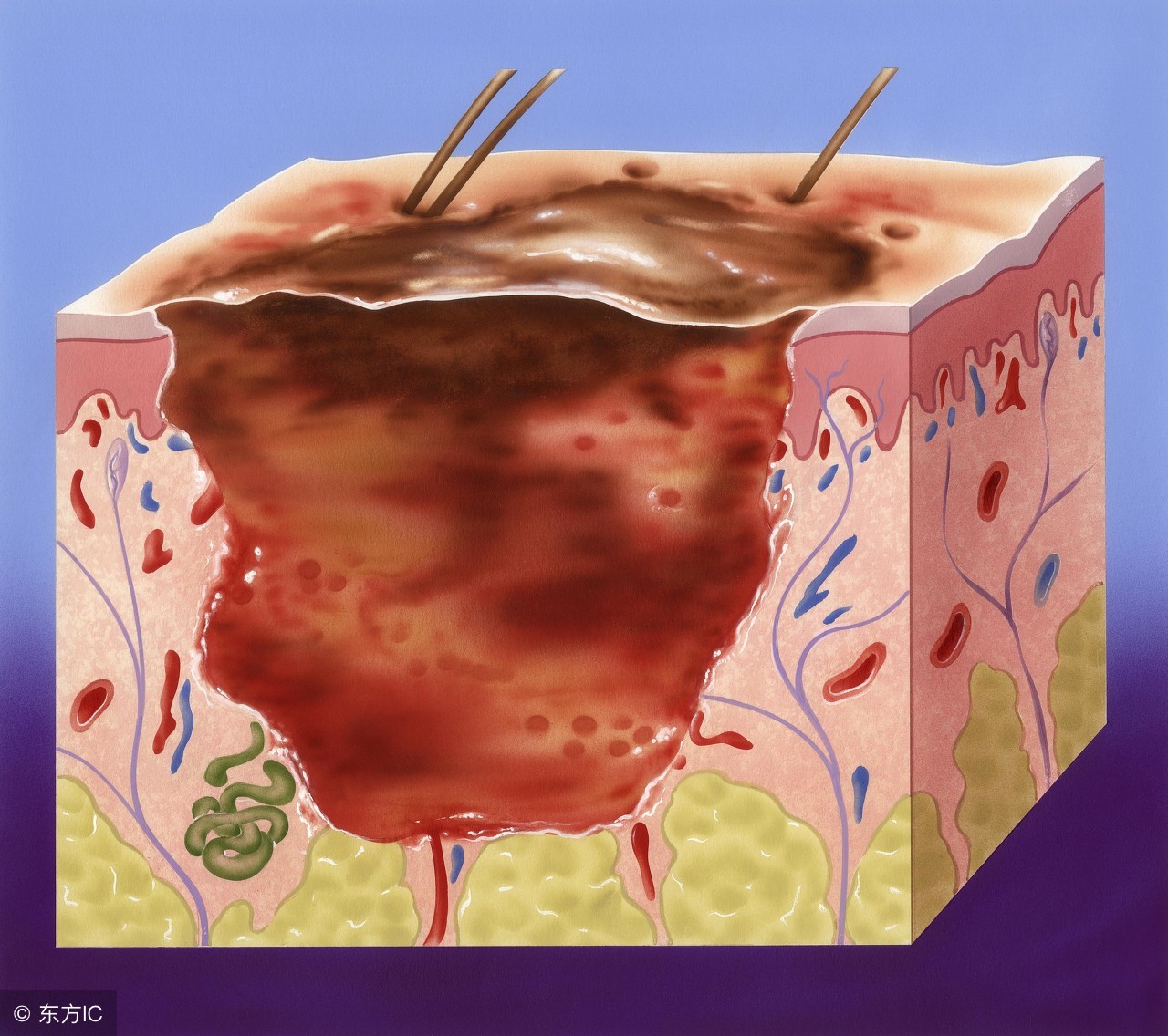 严重烧伤急救措施,严重烧伤病人应采取什么措施