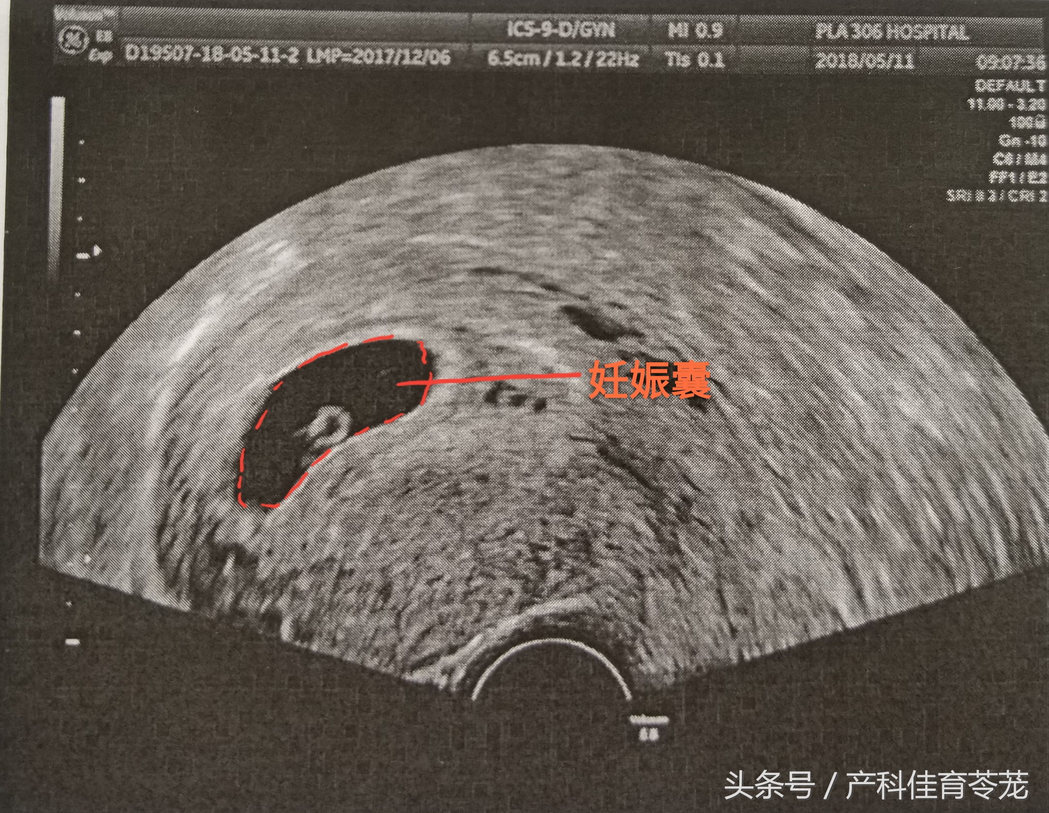 孕期B超数据准确吗,b超医生说的数字
