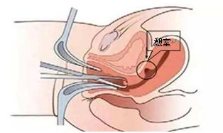 剖宫产引起的例假淋漓不尽怎么办,妇科剖腹产术后月经不干净