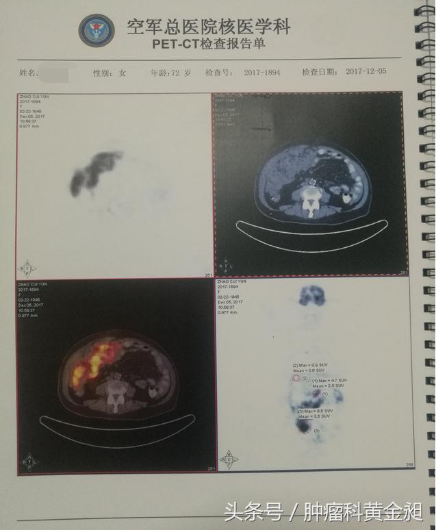 中医治疗卵巢癌晚期,卵巢癌中西医结合治疗能痊愈吗