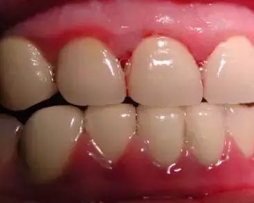 牙齿与牙龈缝处发黑一碰就出血,远离牙龈出血的一点小科普