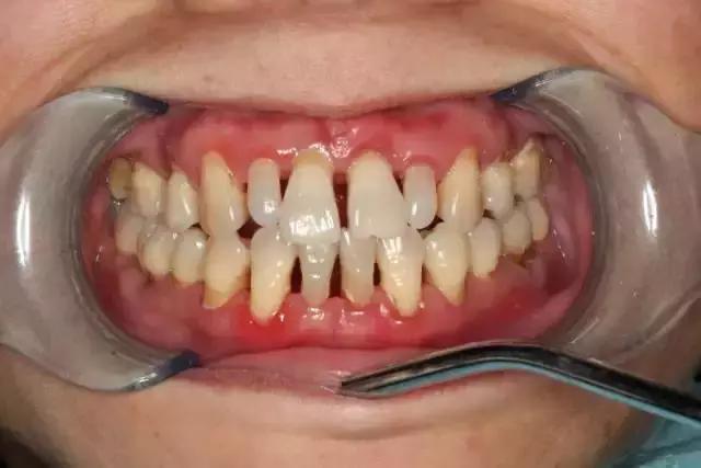 有一个牙齿的牙龈一碰就出血,牙龈萎缩还一碰就出血怎么回事