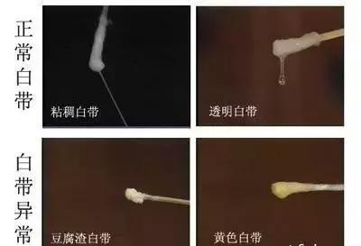 白带多裤子总是湿的怎么办,白带多裤头湿乎乎的怎么可以自愈