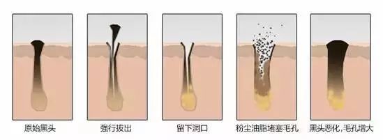 有效去黑头的方法小妙招,6个快速有效去黑头的小妙招
