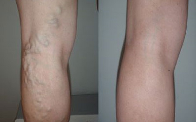 手上青筋怎么治愈呢,可以看到手上的青筋是怎么回事