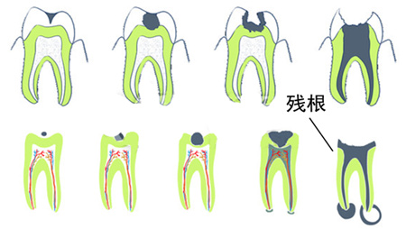 牙齿龋坏就剩牙根怎么处理,牙齿龋坏放任不管能坚持多久