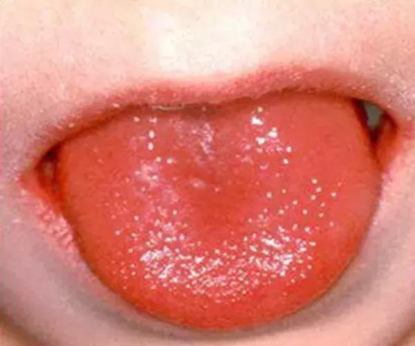 夏季猩红热高发家有娃娃要当心,为什么猩红热高发于儿童