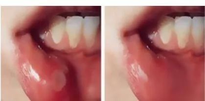 口腔溃疡药5秒止痛,口腔溃疡药1秒止痛