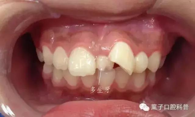 口腔科普儿童换牙常识,儿童换牙后牙缝大需要做矫正吗