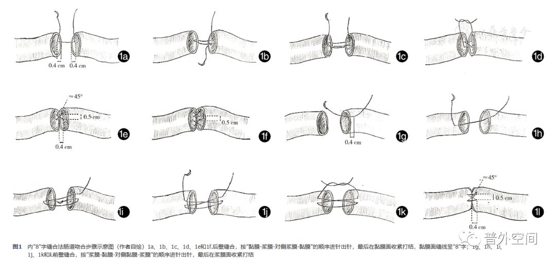 腹腔镜结直肠手术的应用指征,内8字型缝合法详细步骤
