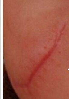 疤痕整形术后恢复过程,疤痕整形手术全过程图示