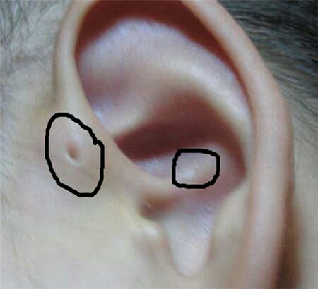 宝宝耳朵有个小洞是什么福气,孩子耳朵上有个富贵洞