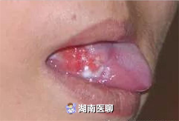舌头烂了是舌头癌吗,如果舌头总破有舌癌风险么