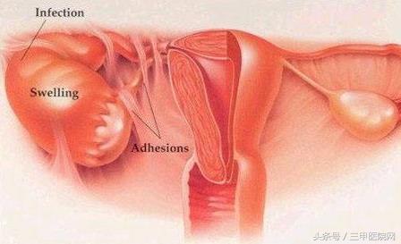 盆腔炎危害是什么,盆腔炎有什么伤害