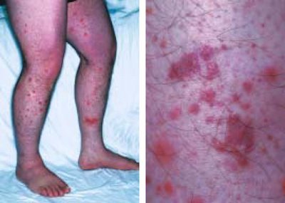 紫癜论坛:中医治疗过敏性紫癜知要