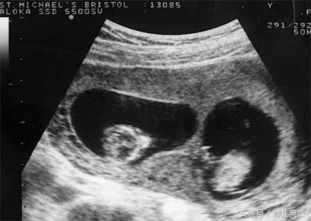 26岁双胎孕妇,27岁的孕妈妈怀孕双胞胎b超单