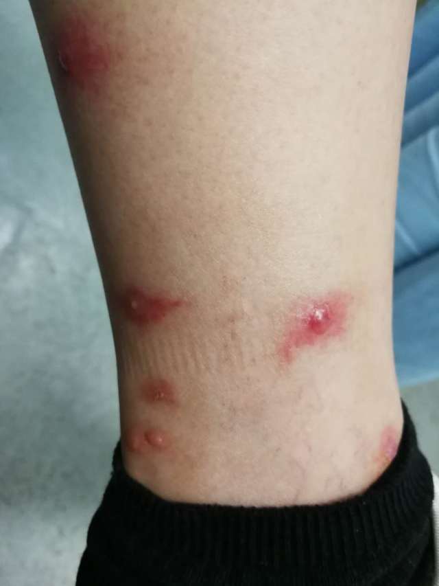 被蚊子咬了起了荨麻疹,被蚊子咬了起荨麻疹