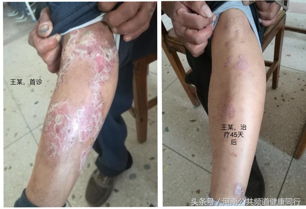 中医刘喜元,刘喜元中医