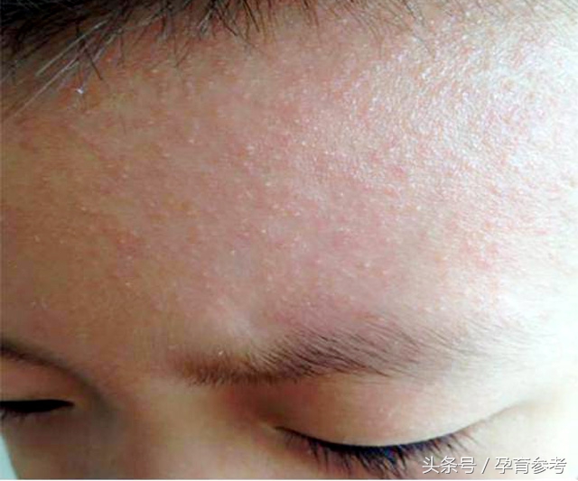 长痱子买花露水还是爽身粉,痱子用十滴水还是痱子粉