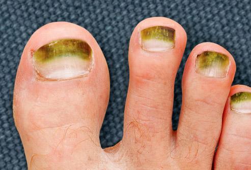 脚趾甲发绿图片,如何判断脚趾甲变色