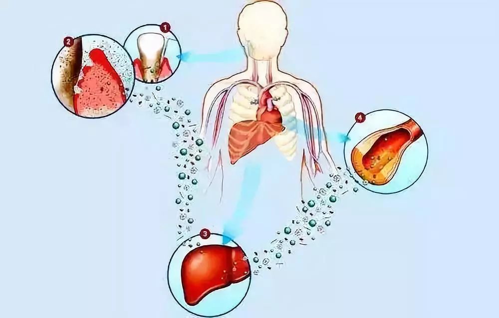 从炎症到癌症的三种病,慢性炎症与癌症的关系