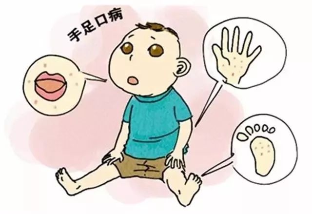 手足口病高发期温馨提示家长,手足口病高发期宝宝家长请注意