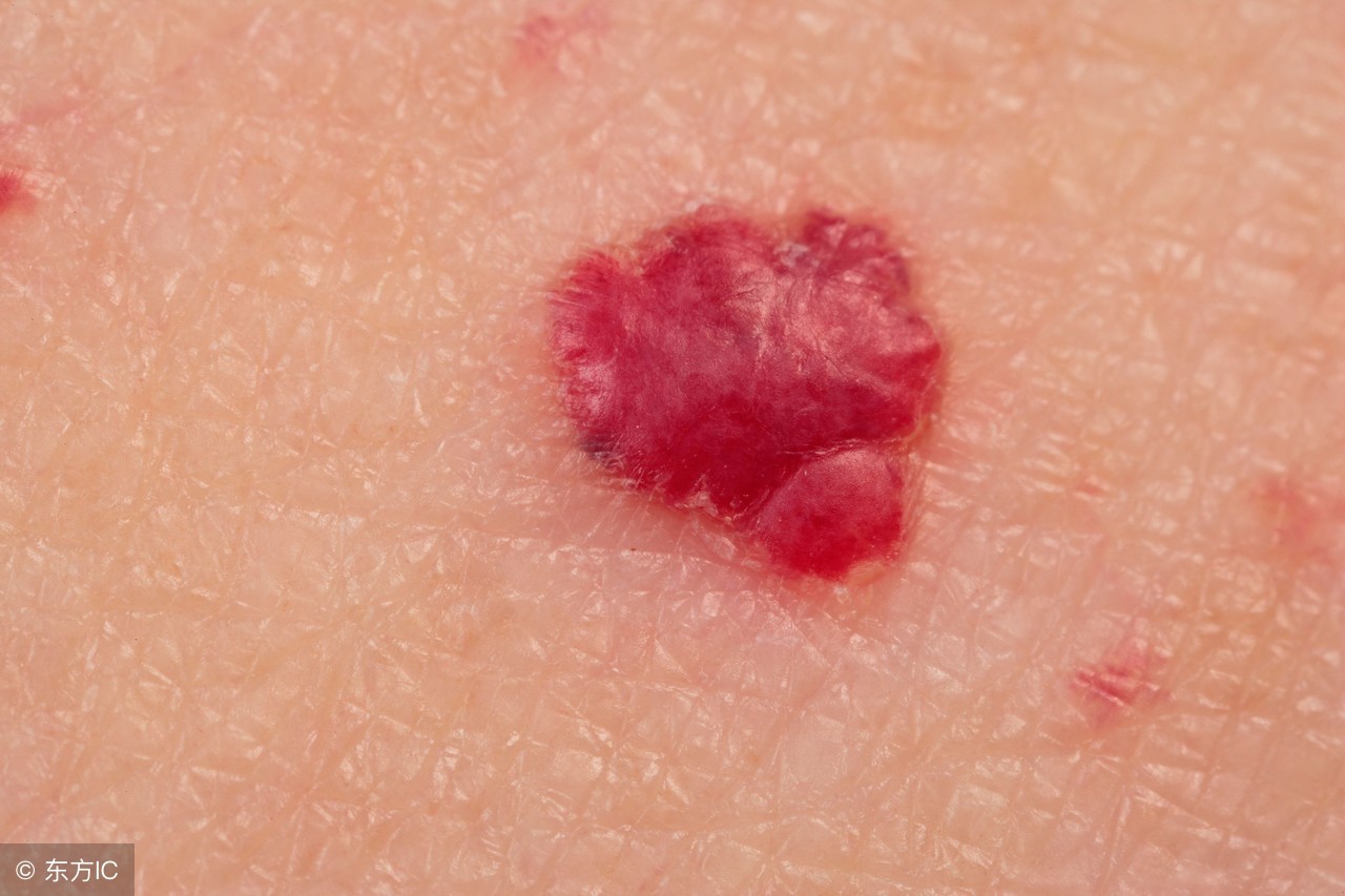 身上长红痣肝功能正常需要注意吗,皮肤上长红痣要当心是肝病的征兆