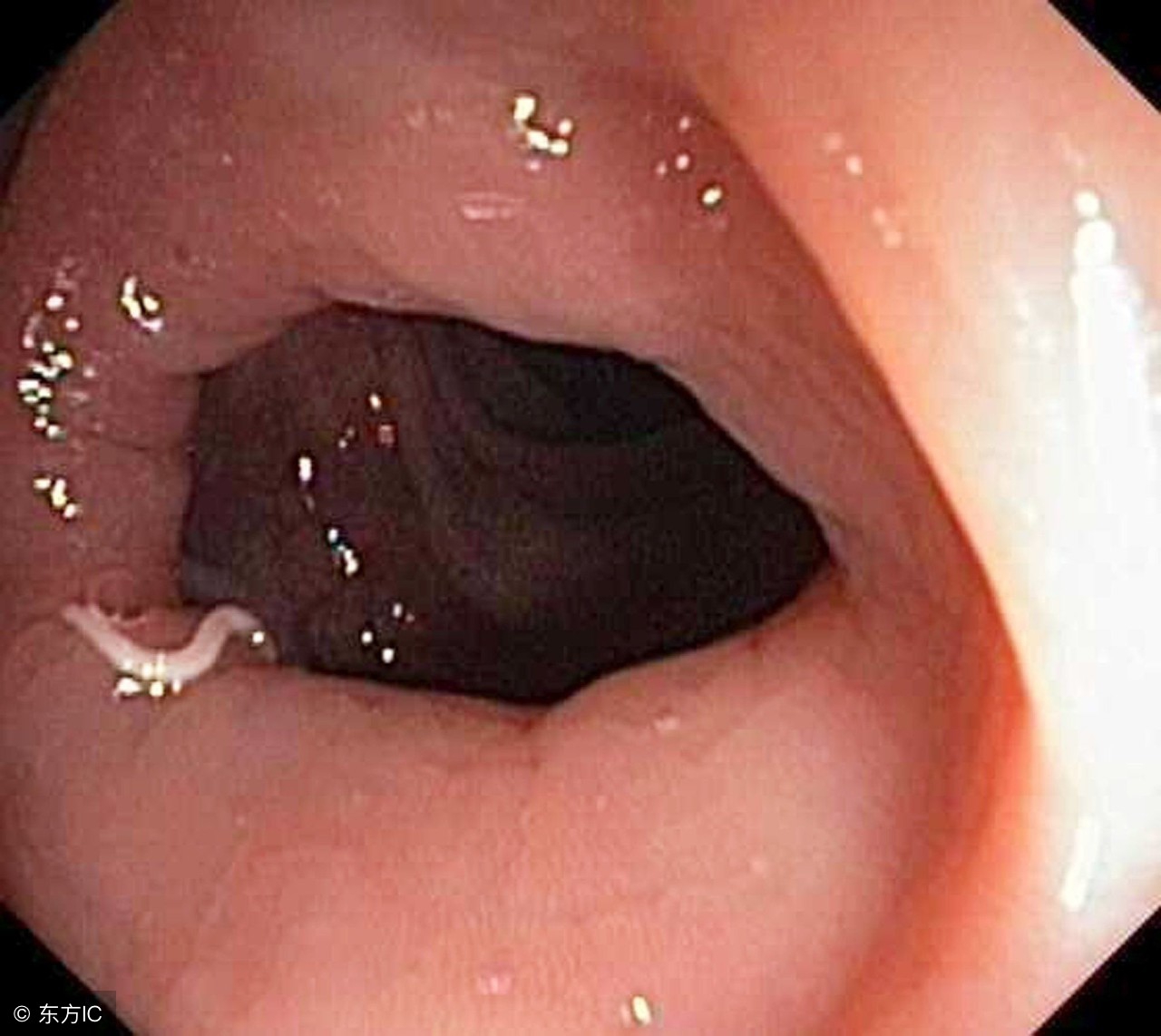 小女孩隐*处私**掉虫子?这个问题不少见
