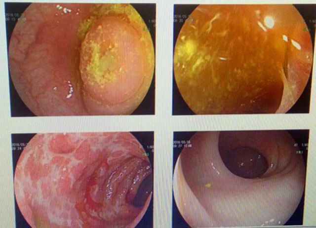 市县专家联动，淳安县中医院成功开展全县首例内镜下逆行阑尾炎治疗术（ERAT）