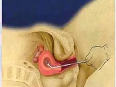 最安全的流产方法是什么,流产的三种类型